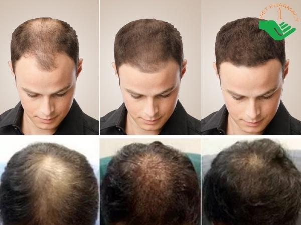 Cách chữa tóc rụng nhiều ở nam đơn giản