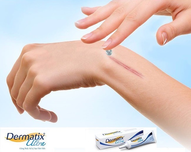 Kem hỗ trợ trị sẹo Dermatix Ultra 15g