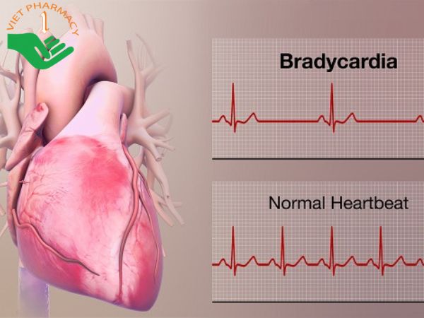 Nhịp tim đập nhanh hơn hoặc châm hơn mức bình thường nghĩa là bạn đã mắc chứng rối loạn nhịp tim