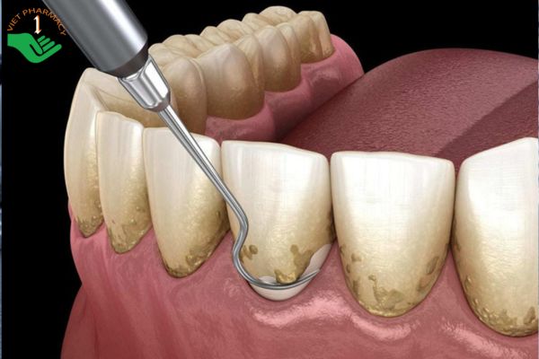 Xịt chống sâu răng giúp loại bỏ mảng bám cứng đầu