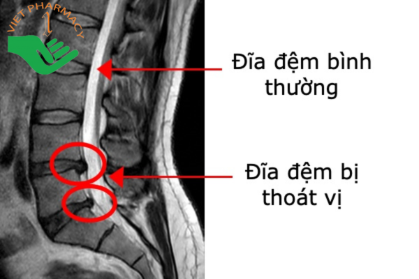 MRI có thể giúp nhận diện được thoát vị đĩa đệm