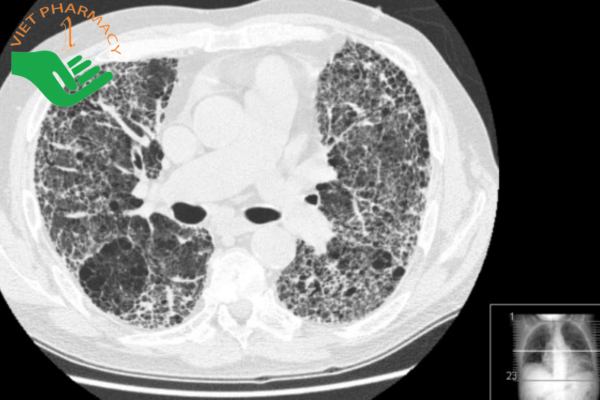 Hình ảnh CT xơ hóa thùy trên của phổi gặp trong viêm cột sống dính khớp