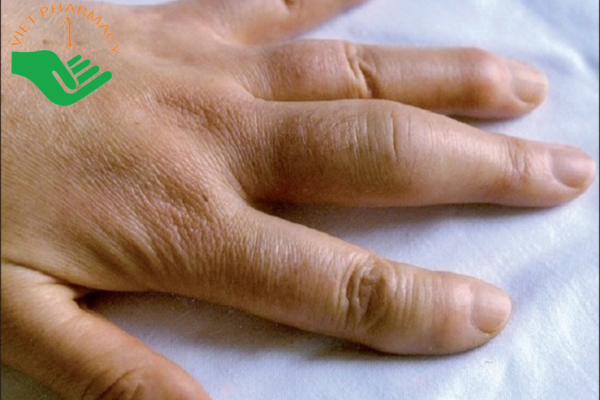 Triệu chứng viêm ngón tay trong viêm cột sống dính khớp