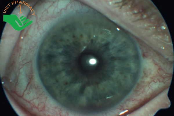 Viêm màng bồ đào mắt (P) do viêm cột sống dính khớp
