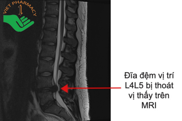 Hình ảnh thoát vị đĩa đệm L4 L5 nhìn thấy trên MRI
