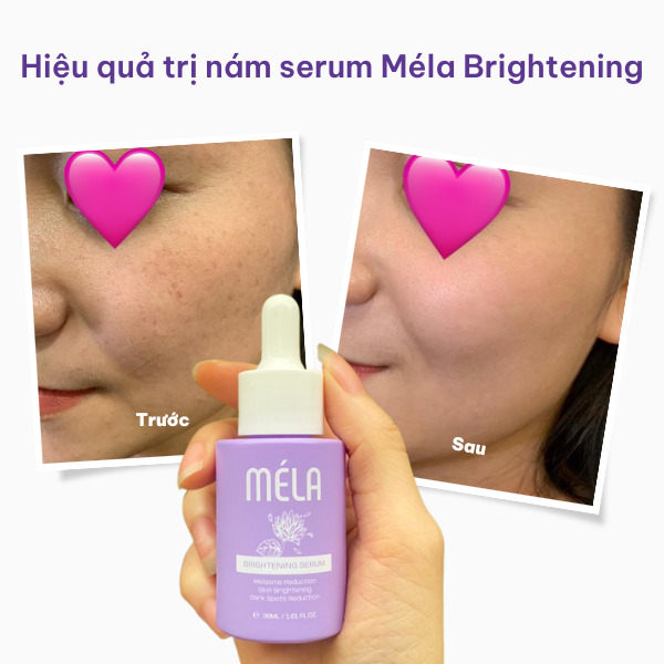 Hiệu quả trị nám sáng da của serum Méla Brightening