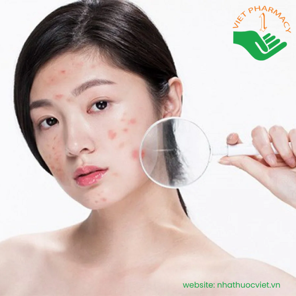 Murad Rapid Relief Acne Spot Treatment 4h có thể gây châm chích khi dùng