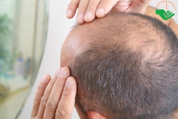 Rụng tóc ở Nam giới Nguyên nhân  cách điều trị bệnh hiệu quả