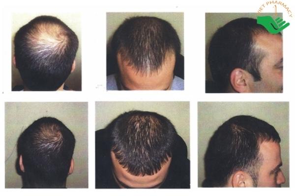 6 kiểu tóc cho trán cao nam thịnh hành che khuyết điểm dồ hói