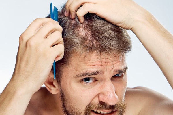 Nguyên nhân chính gây rụng tóc ở nam giới