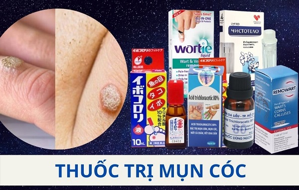 Thuốc trị mụn cơm, mụn cóc: Giải pháp hiệu quả và an toàn cho làn da của bạn