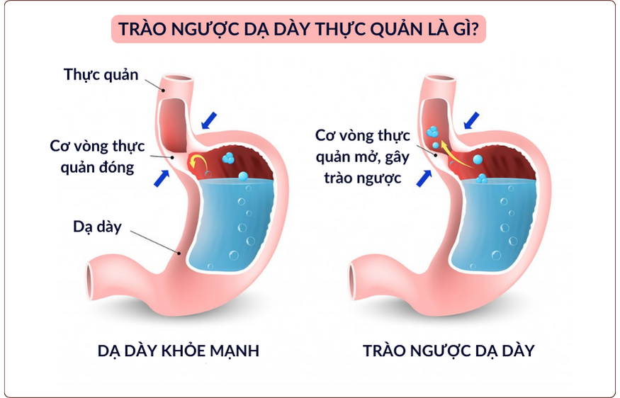 Dịch axit trong dạ dày bị trào ngược ra ngoài gây ra các triệu chứng khó chịu