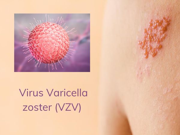 Bệnh zona thần kinh do virus Varicella zoster gây ra