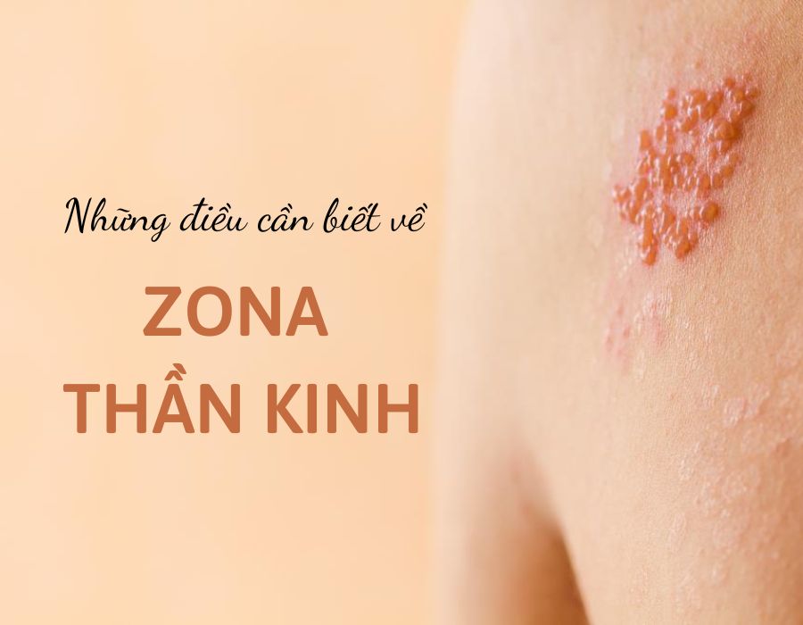 Nếu không vệ sinh sạch sẽ vết zona thần kinh, những rủi ro gì có thể xảy ra?
