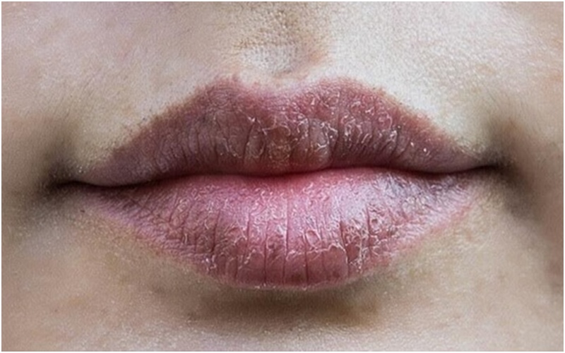 Khử thâm môi là gì?