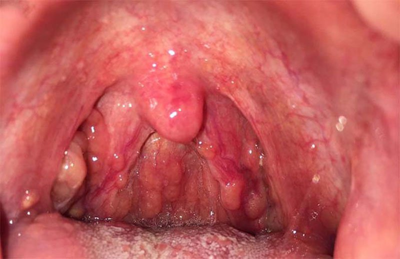 Viêm họng hạt gây vướng ở cổ họng nhưng không đau