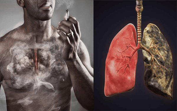 Bệnh ung thư phổi có thể hình thành do nhiều nguyên nhân