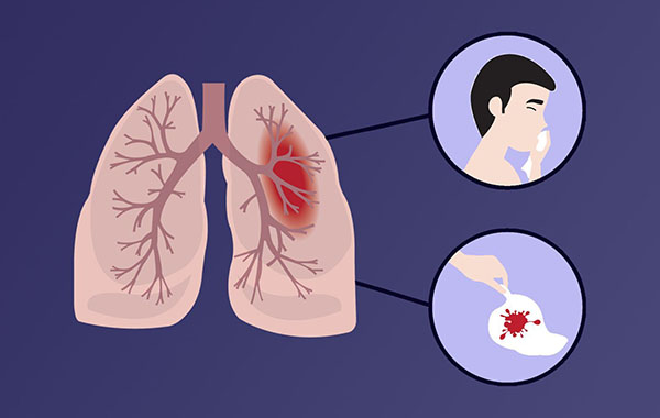 Ho ra máu là 1 triệu chứng khác của căn bệnh ung thư phổi