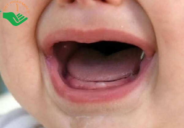 Mọc răng khiến trẻ sơ sinh đi ngoài có mùi chua và nhầy