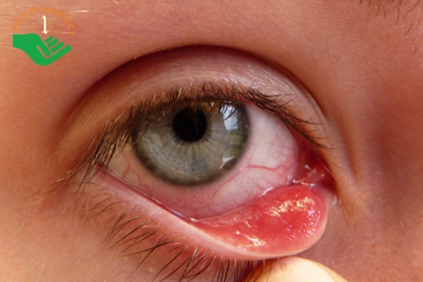Viêm bờ mi là một trong những nguyên nhân gây ngứa ở khu vực khóe mắt