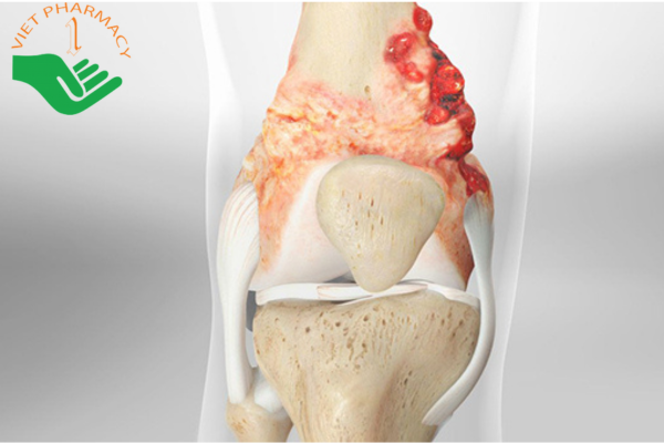 Sự tăng sinh bất thường của các tế bào xương