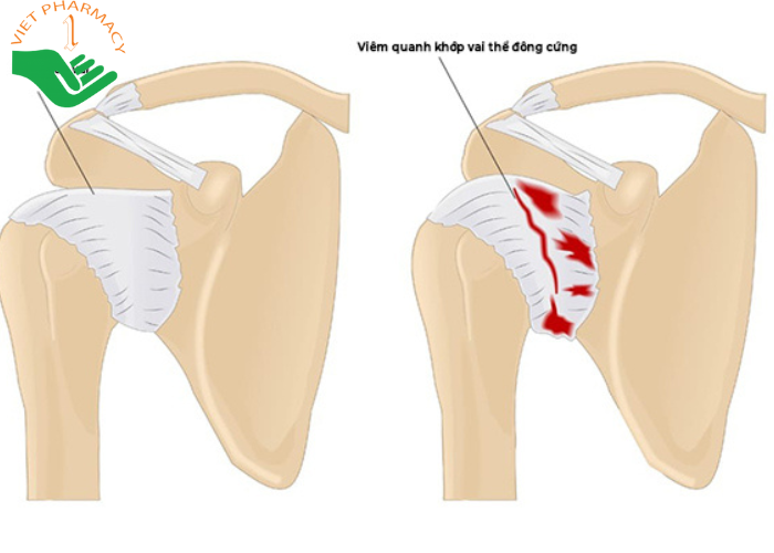 Triệu chứng của viêm quanh khớp vai đa dạng tùy thể bệnh