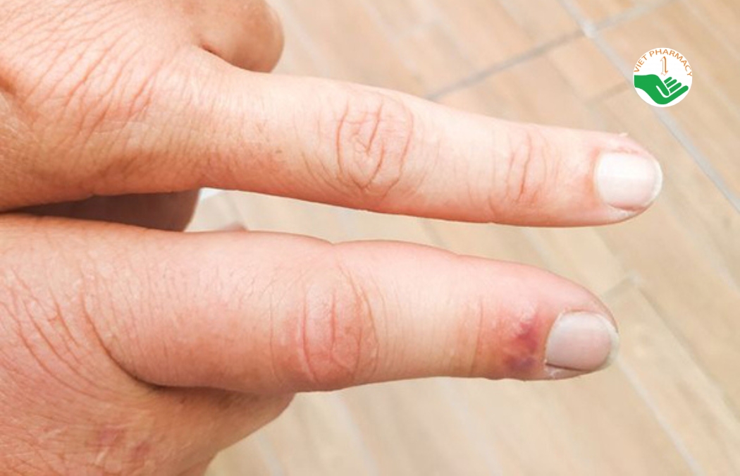 Triệu chứng ngón tay xúc xích trong viêm khớp vảy nến