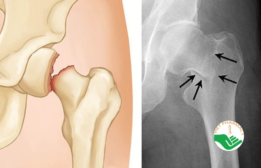 Gãy cổ xương đùi là một chấn thương nghiêm trọng