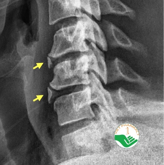 X-quang là phương tiện hình ảnh đơn giản giúp chẩn đoán gai cột sống