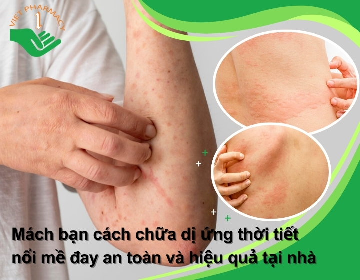 Mách bạn cách chữa dị ứng thời tiết nổi mề đay an toàn và hiệu quả tại nhà