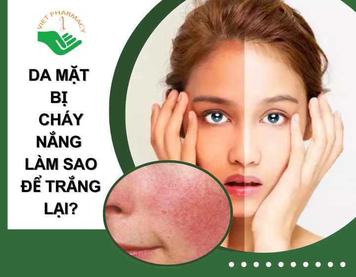 Da mặt bị cháy nắng làm sao để trắng lại​? Cách phục hồi hiệu quả